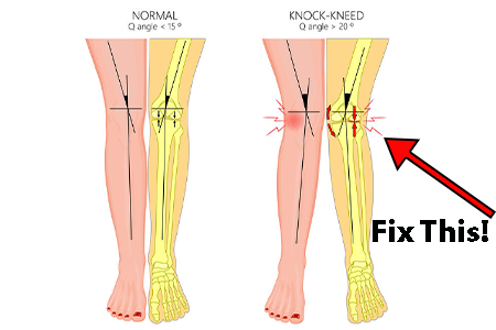 best insoles for knock knees