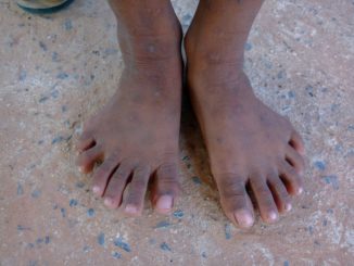 Woman With Six Toes