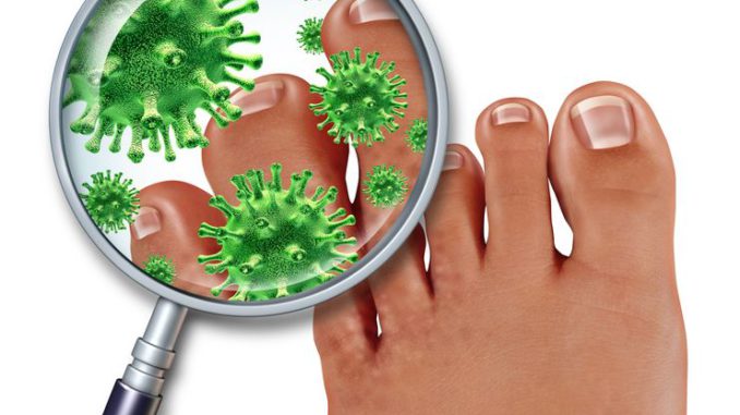Toenail Fungus toenail-fungus
