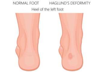women's-shoes-for-haglund's-deformity
