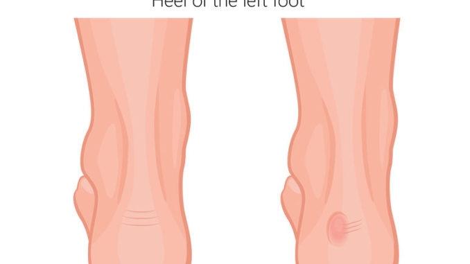 best women's shoes for haglund's deformity