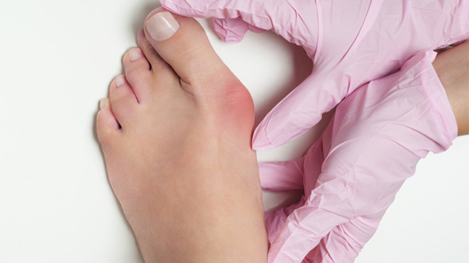 Woman with Bunions